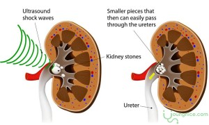 Treatment methods for 6-7mm kidney stones