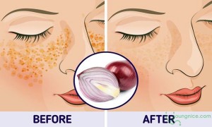 The effect of purple onions in reducing acne and preventing dark spots
