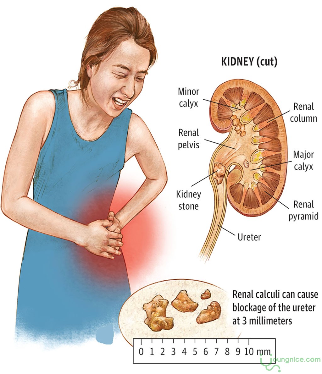 kidney stones hut