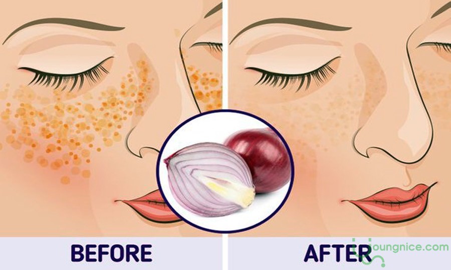 The effect of purple onions in reducing acne and preventing dark spots