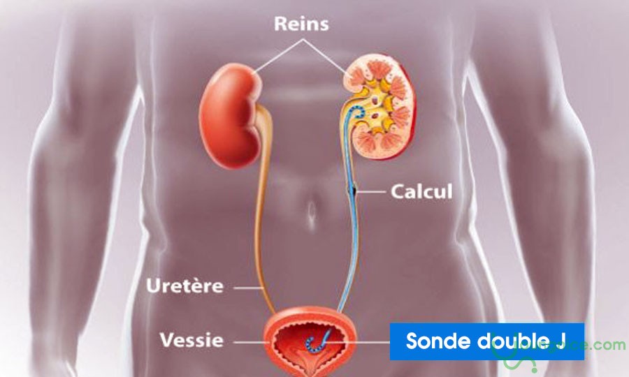 Characteristics and Uses of Ureteral Stents