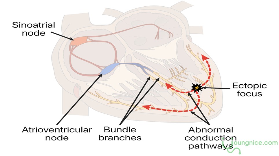 Extraventricular premature beats: Causes, symptoms, prevention, and treatment