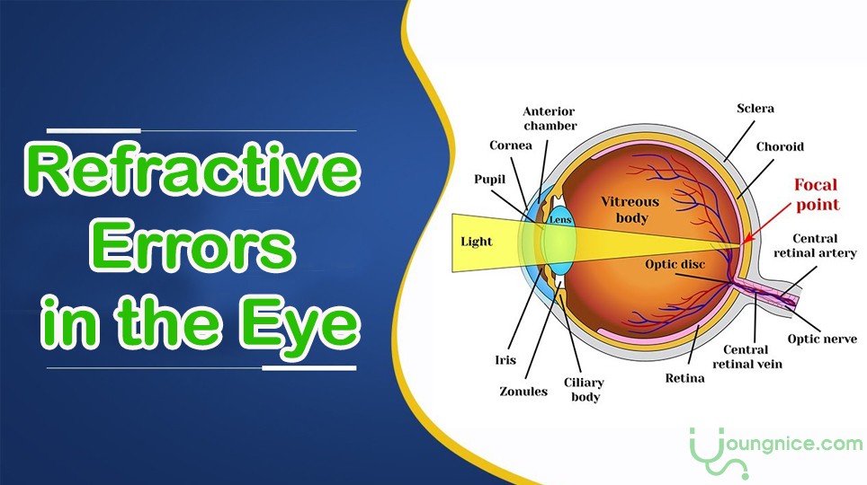 Refractive Errors in the Eye: Causes and Treatment